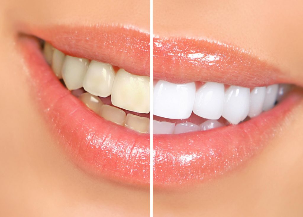 BLANCHIMENT DES DENTS